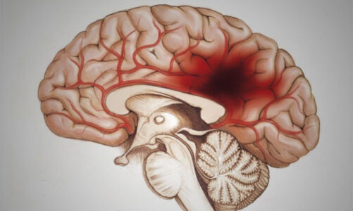 Nuevas formas de prevenir el ACV por vasos sanguíneos cerebrales