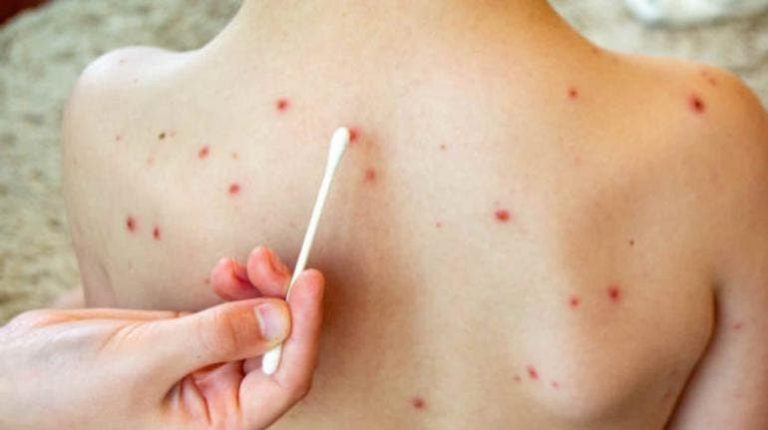 México enfrenta grave crisis de sarampión, encabeza mortalidad