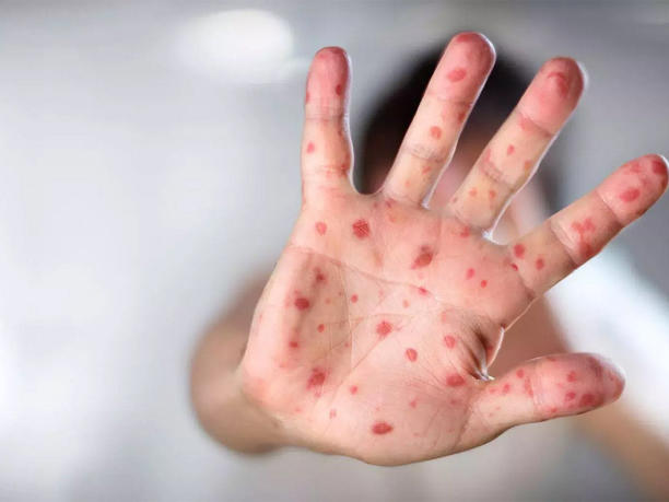 CDMX registra 5 nuevos casos de sarampión en la última semana