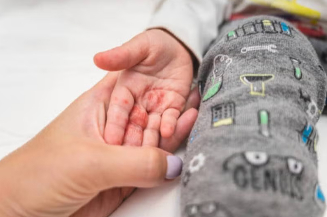 Sarampión vuelve a encender alertas tras muerte de un menor en Tlaxcala