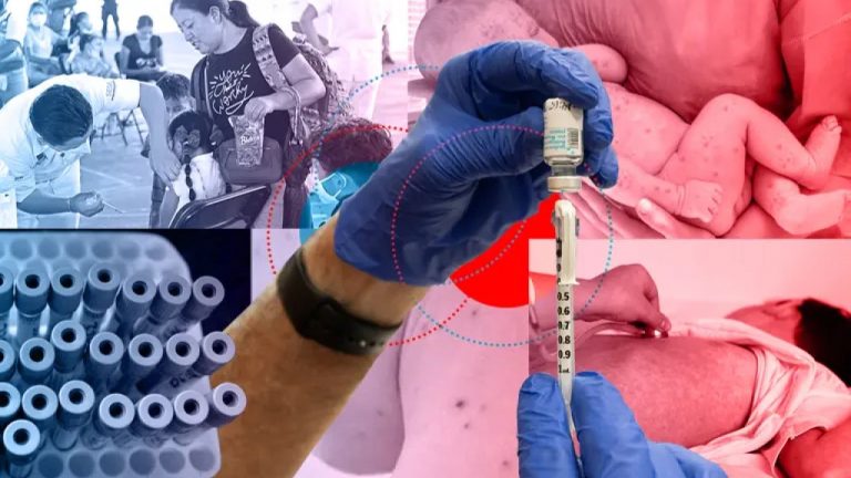 Revisará OPS informes de México y EU por los brotes de sarampión