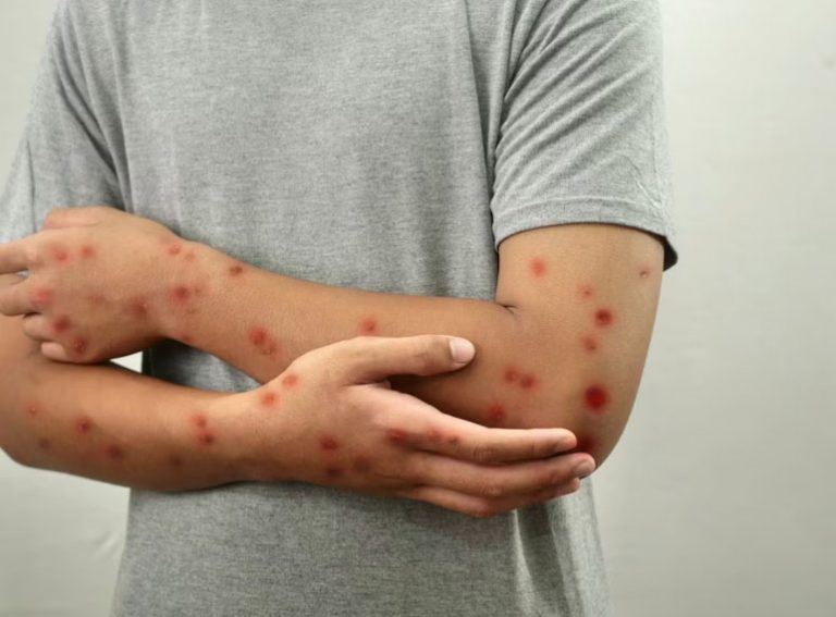 Confirman la primera muerte por sarampión en CdMx