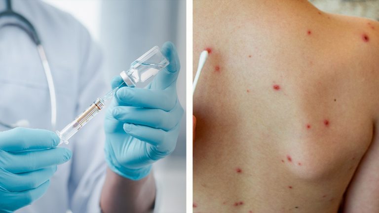 México acumula 10 mil 439 casos confirmados de sarampión