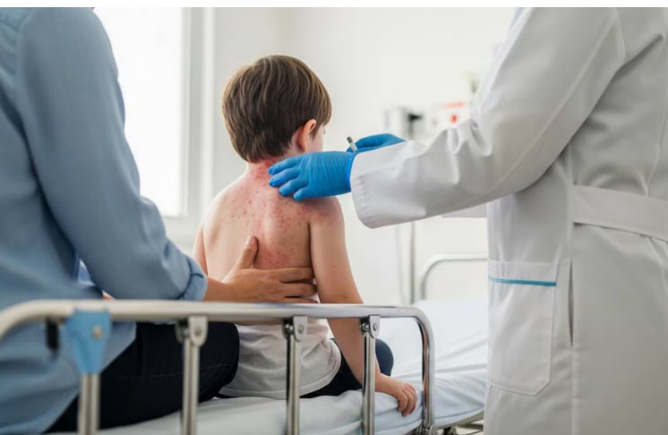 Sarampión en México hoy domingo 15 de marzo, Jalisco estado que encabeza los casos acumulados